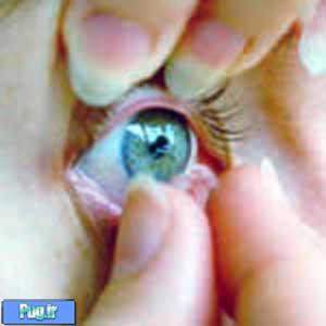 بیماری های چشمی