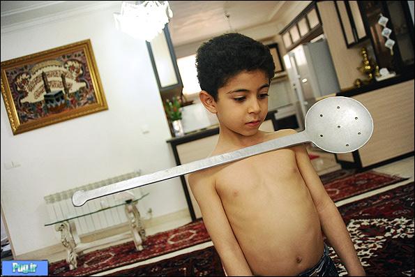 متین ، کودکی با بدن عجیب در تبریز ! + عکس
