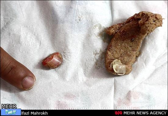 پیداشدن بند انگشت انسان در بسته همبرگر در قم!! + عکس