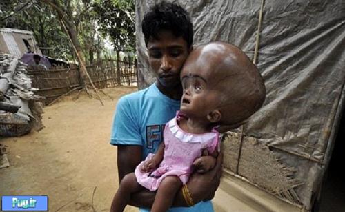 بیماری نادر و دردناک یک دختر بچه! + عکس