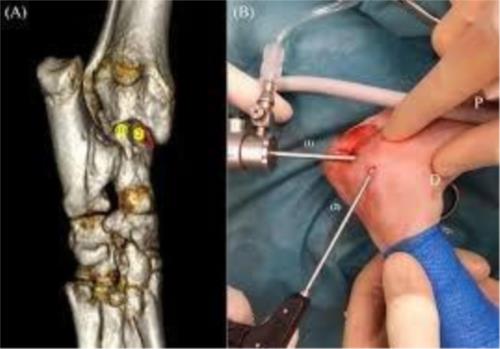 ارتروسکوپی پرشین پت