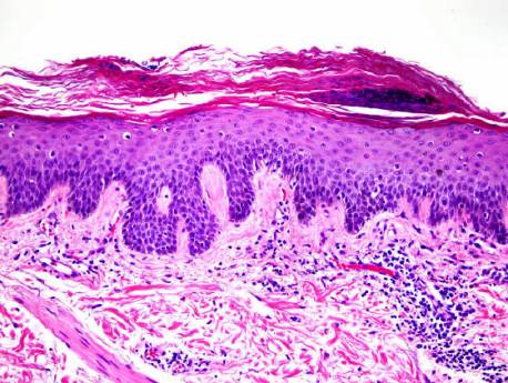 درماتوفیتوز (Dermatophytosis) 